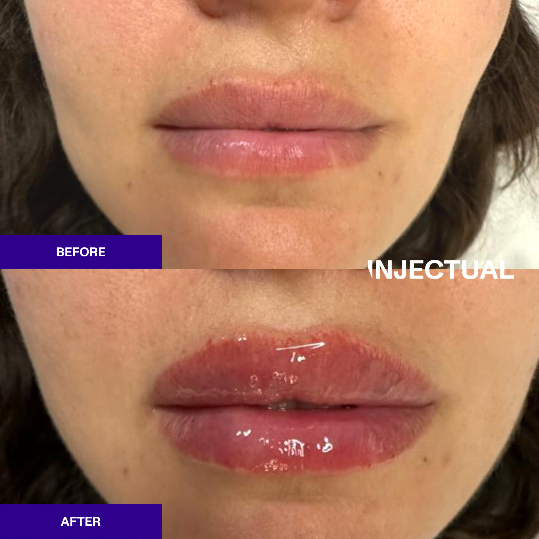 The INJECTUAL Lip