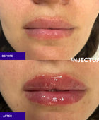 The INJECTUAL Lip