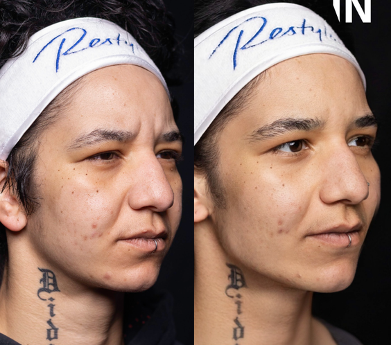 Non-Surgical Masculinisation Treatment