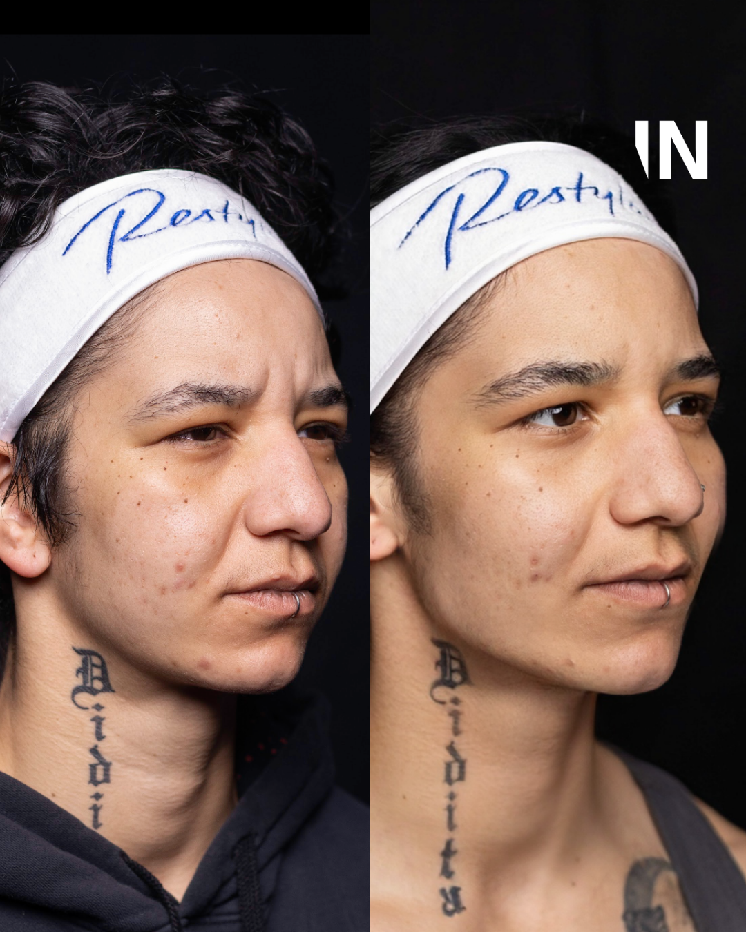 Non-Surgical Masculinisation Treatment