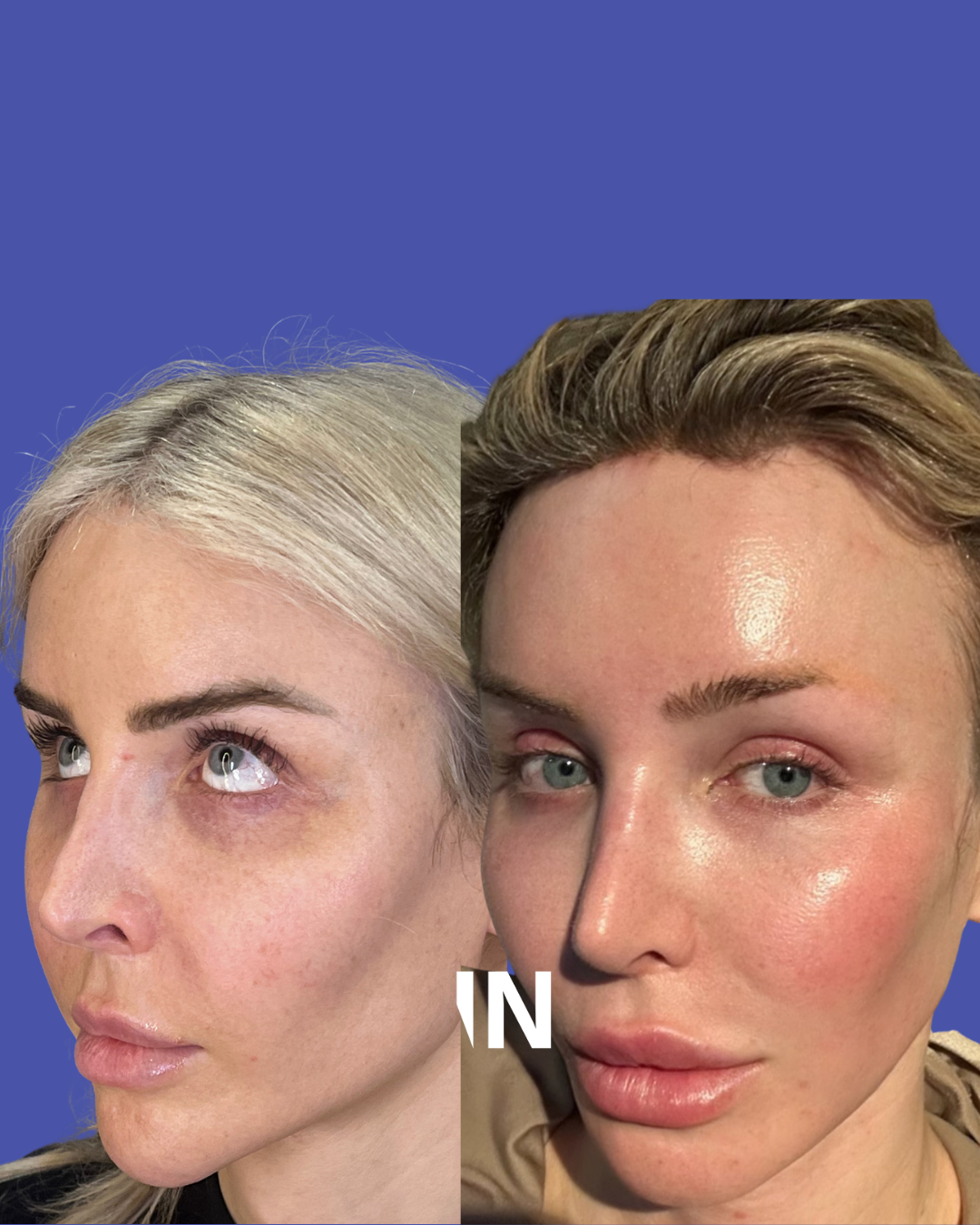 The Injectual Polynucleotide Cocktail XL