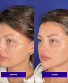 The INJECTUAL Artistic Transformation (Facelift)