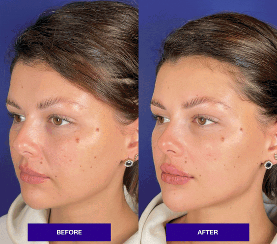 The INJECTUAL Artistic Transformation (Facelift)