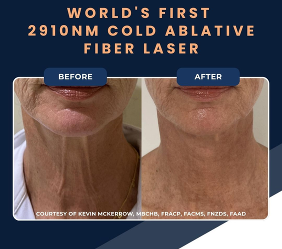 UltraClear Laser Skin Resurfacing