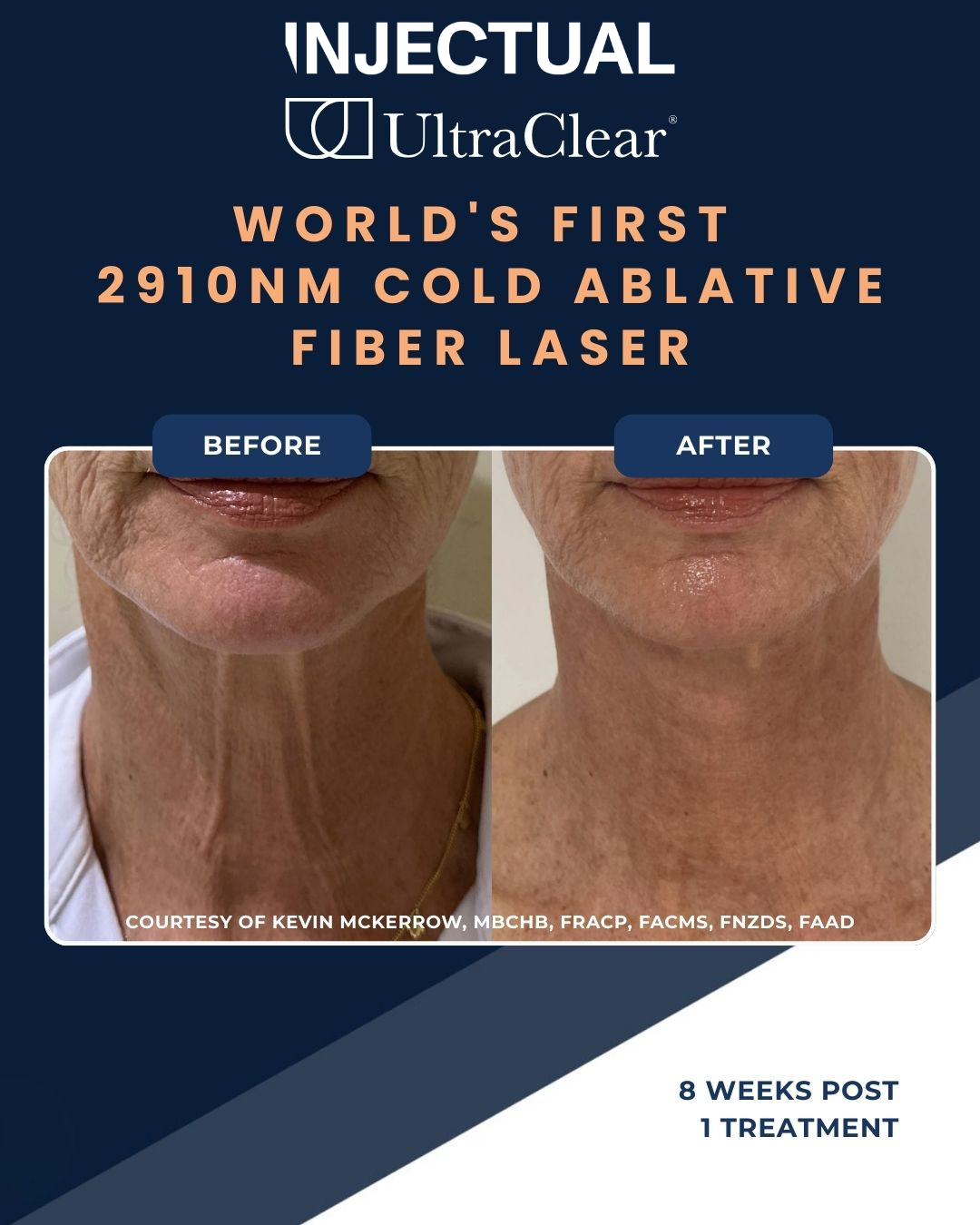 UltraClear Laser Skin Resurfacing