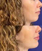 Chin Filler