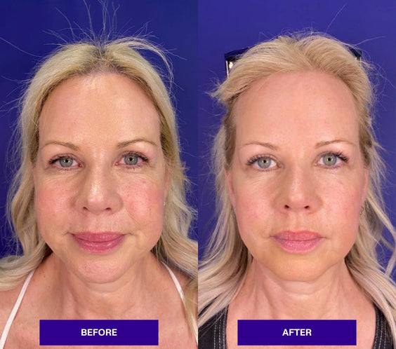 Anti-wrinkle treatment with Alluzience (Express Toxin)