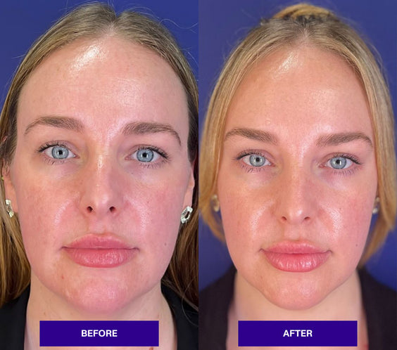 THE INJECTUAL No-Filler Lift