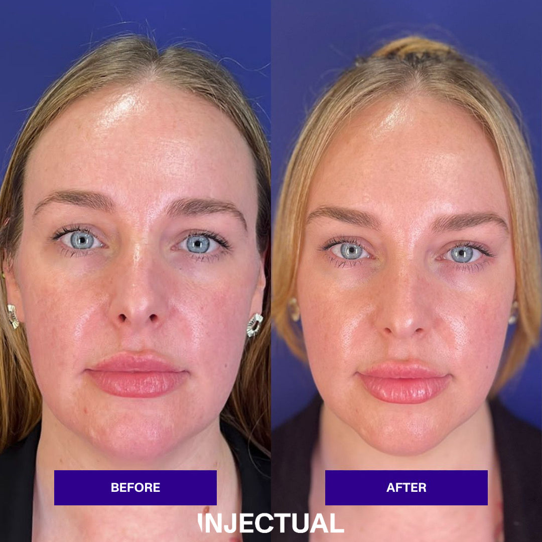 THE INJECTUAL No-Filler Lift