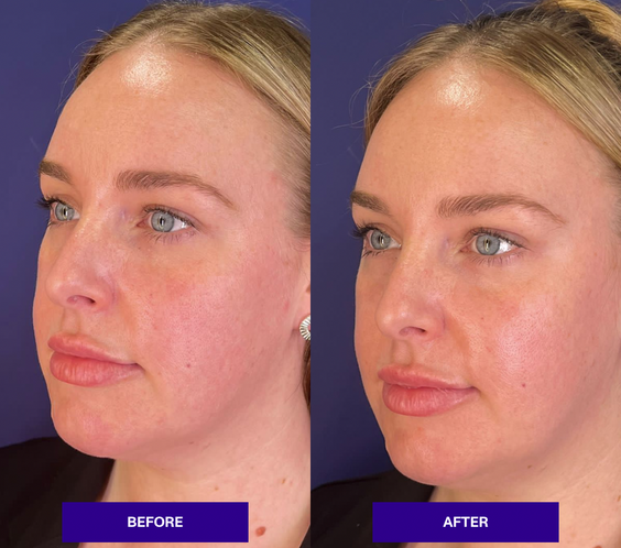 THE INJECTUAL No-Filler Lift