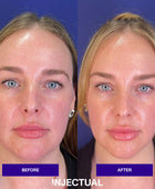 THE INJECTUAL No-Filler Lift