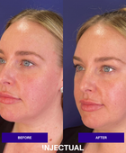 THE INJECTUAL No-Filler Lift