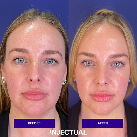 Trapezius Front Injection Traptox aka Trapezius Botox Treatment in London | Injectual