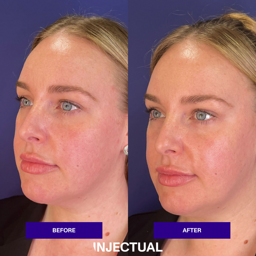 THE INJECTUAL No-Filler Lift