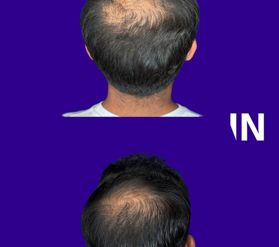 Hair Rejuvenation for Men