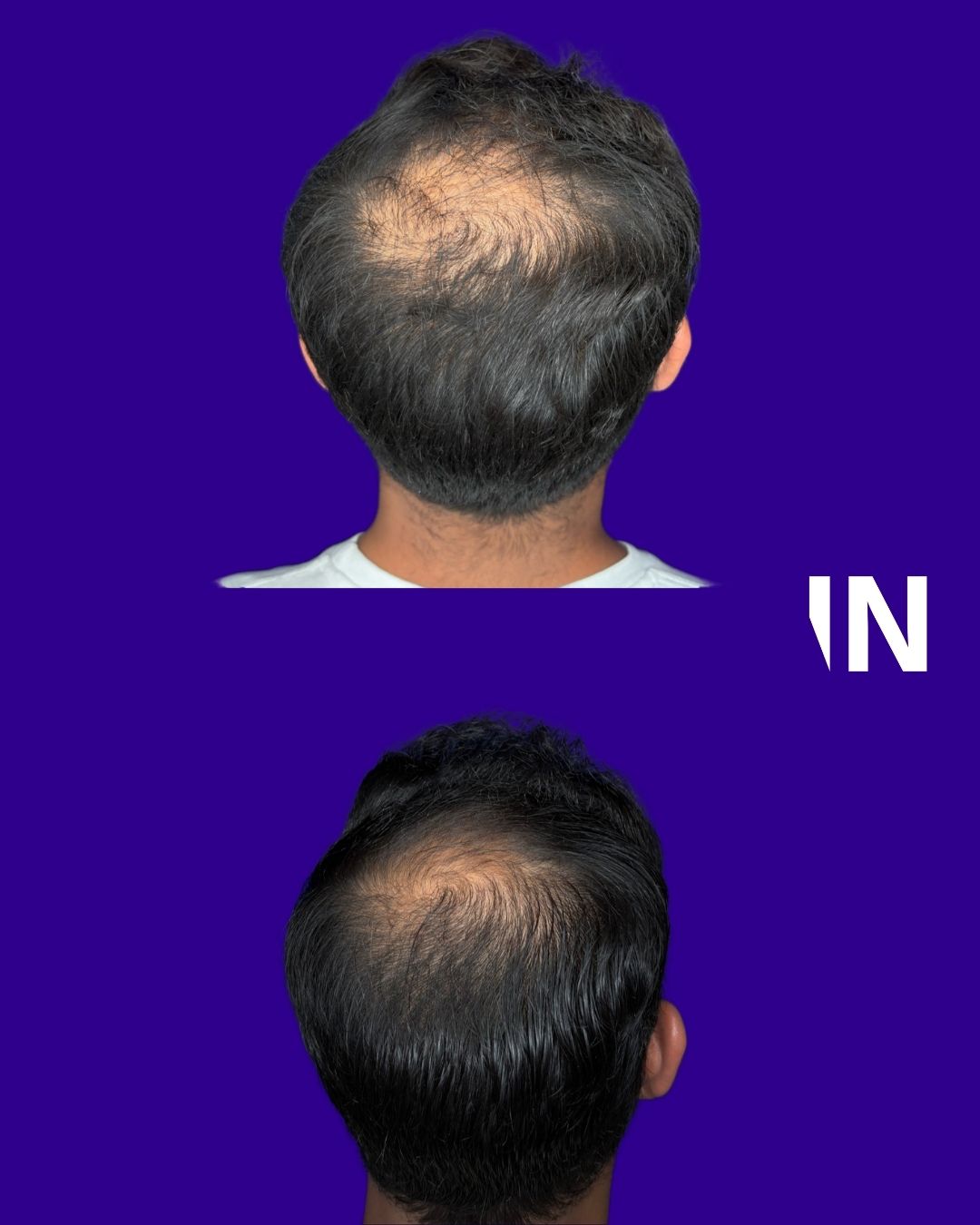Hair Rejuvenation for Men