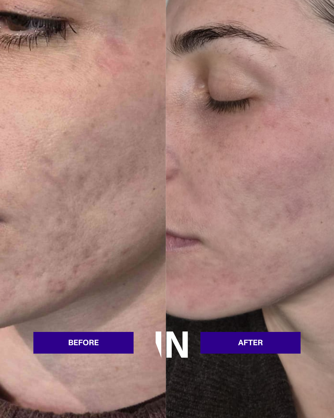 The Insta-Injectual Facial