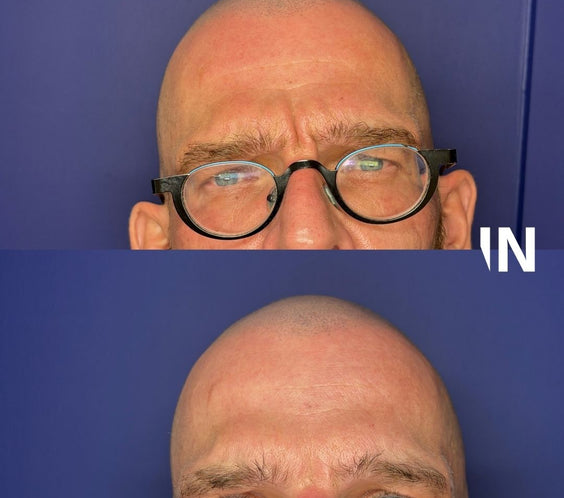 Anti-Wrinkle Treatments for Men