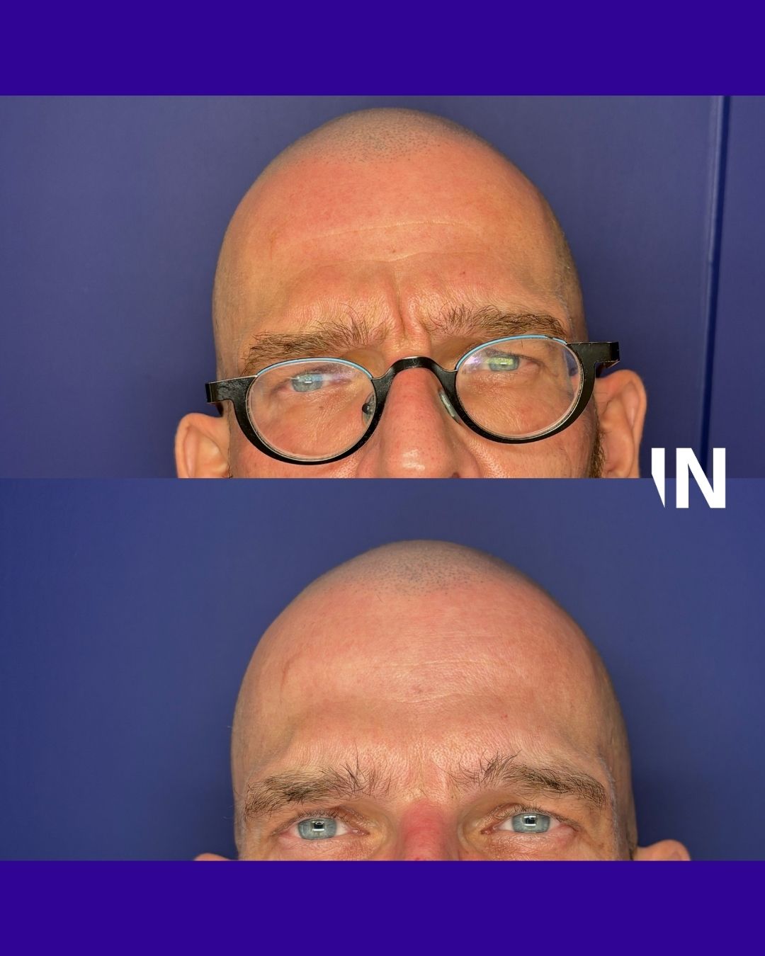 Anti-Wrinkle Treatments for Men