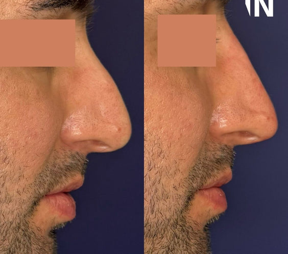 Nose Filler for Men London