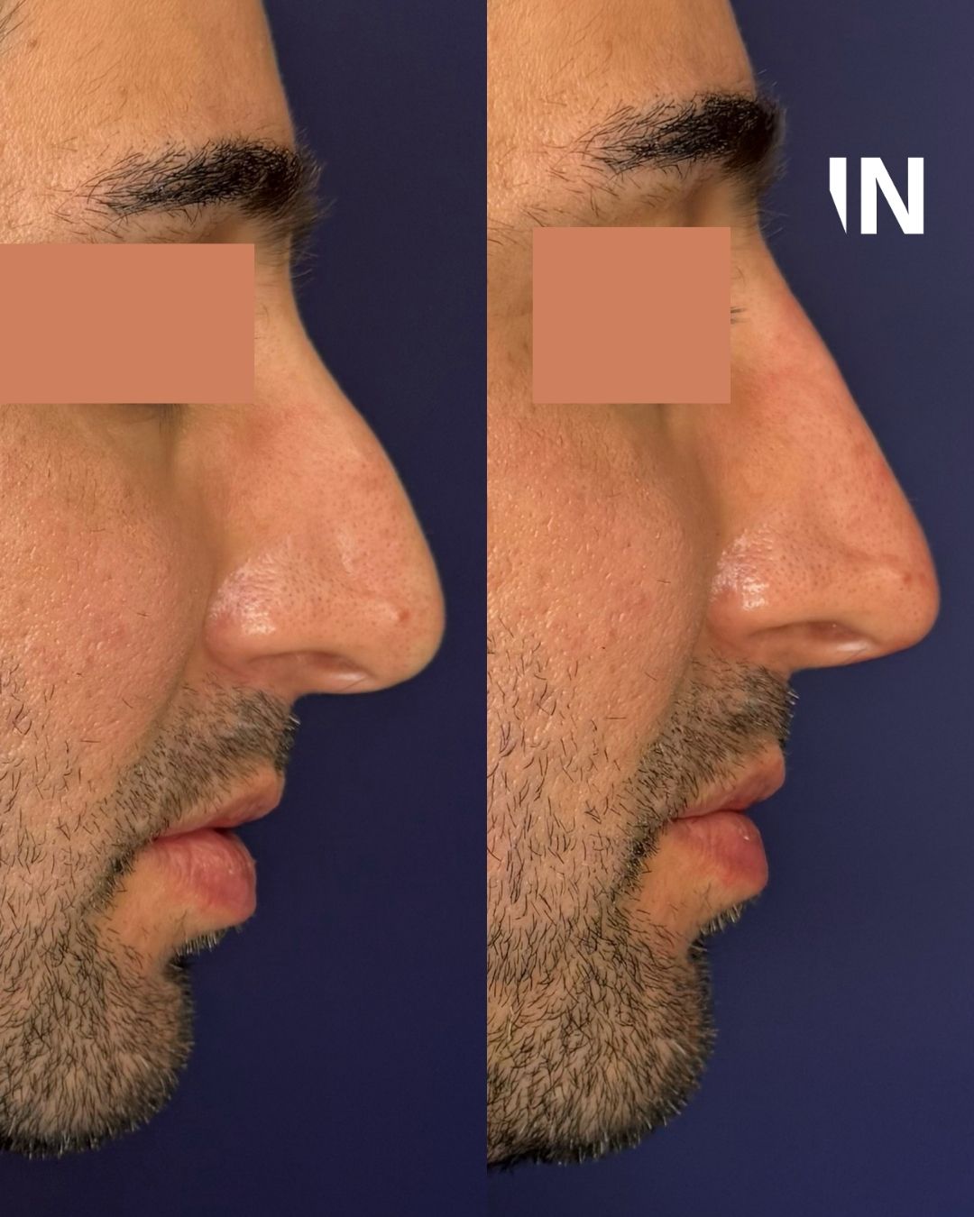 Nose Filler for Men London