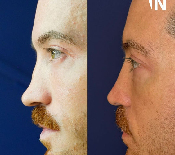Nose Filler for Men London