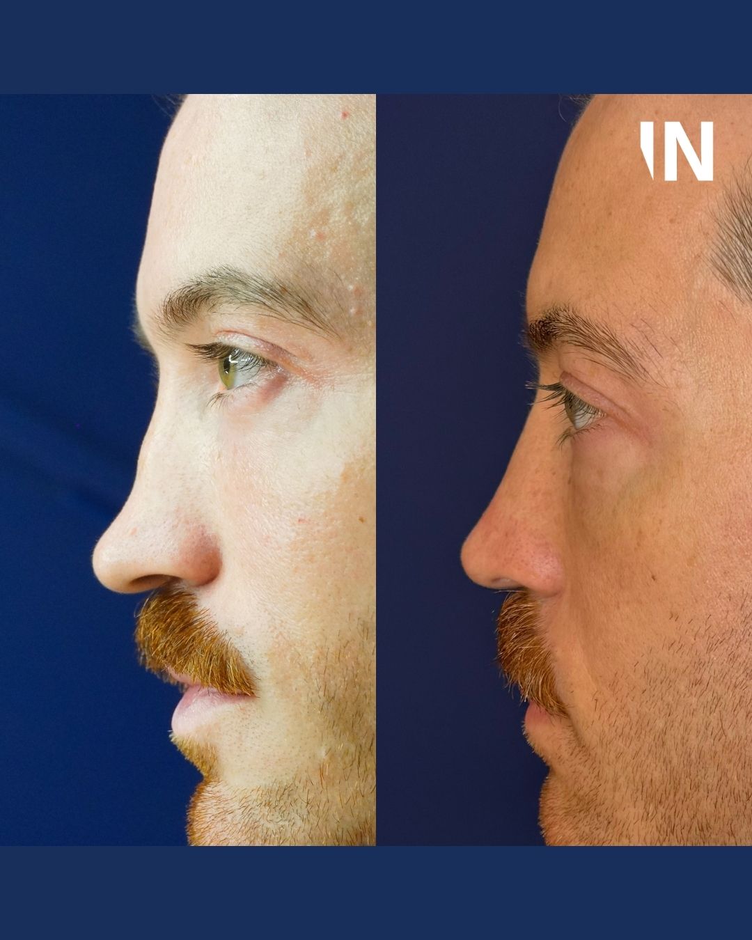 Nose Filler for Men London
