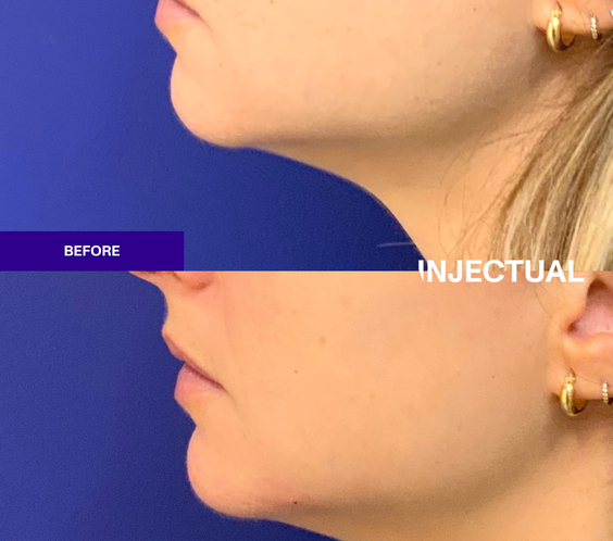 Nefertiti Neck Lift