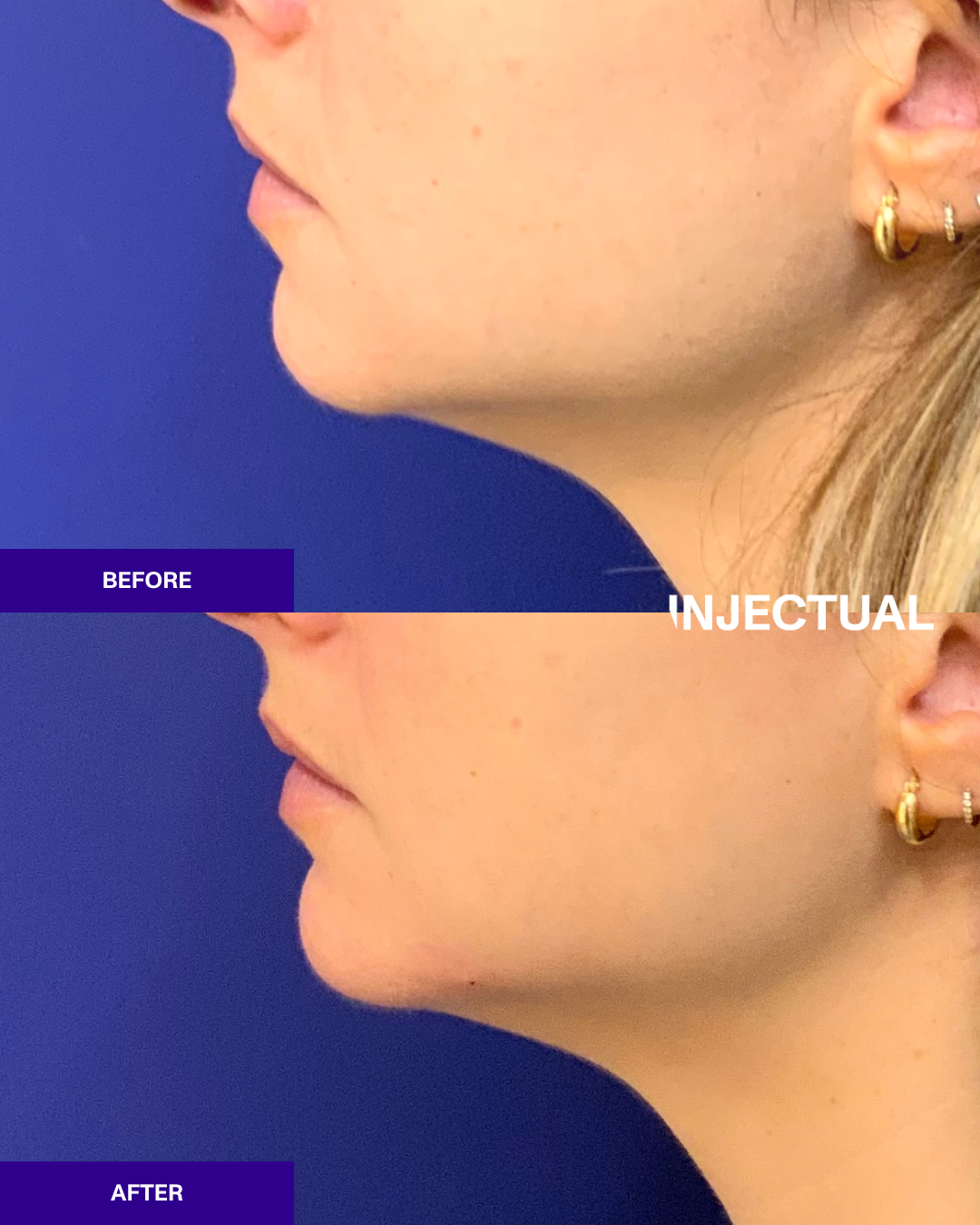 Nefertiti Neck Lift