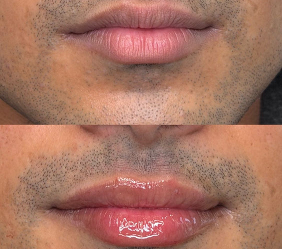 Lip Filler for Men