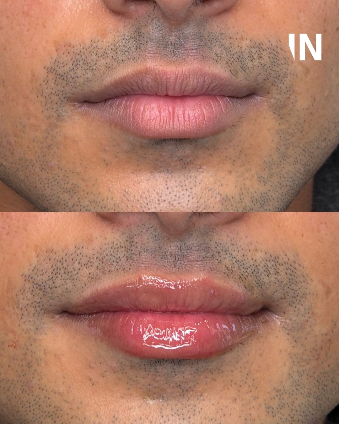 Lip Filler for Men