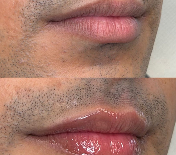 Lip Filler for Men