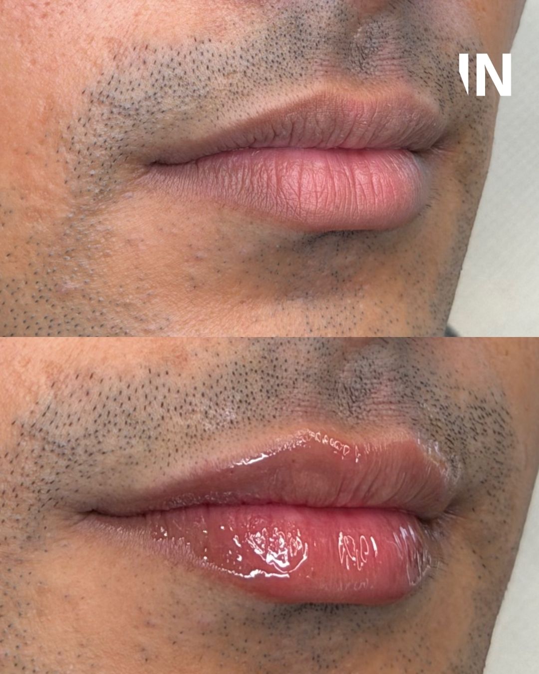 Lip Filler for Men