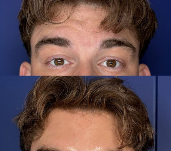 Anti-Wrinkle Treatments for Men