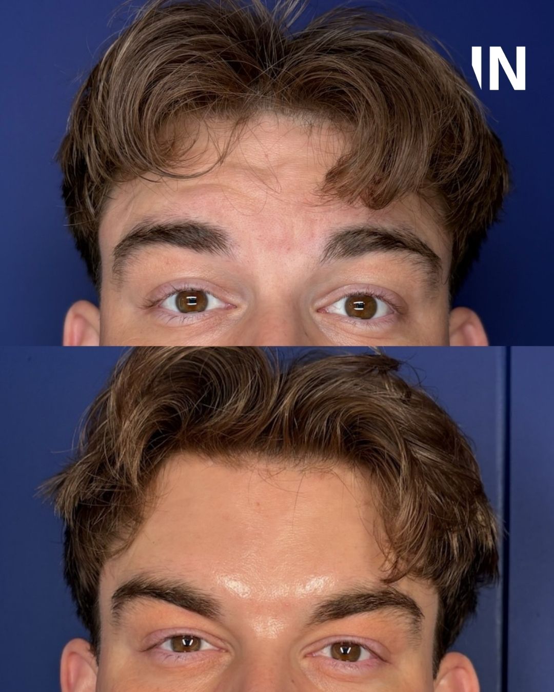 Anti-Wrinkle Treatments for Men