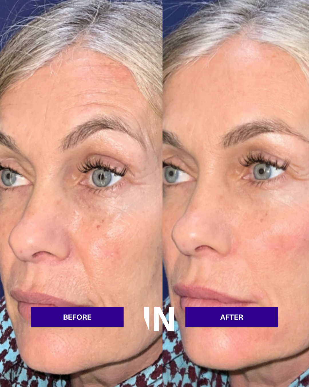 Polynucleotides Treatment for Jowls