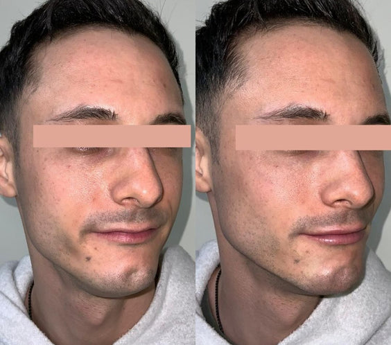 Chin Filler for Men