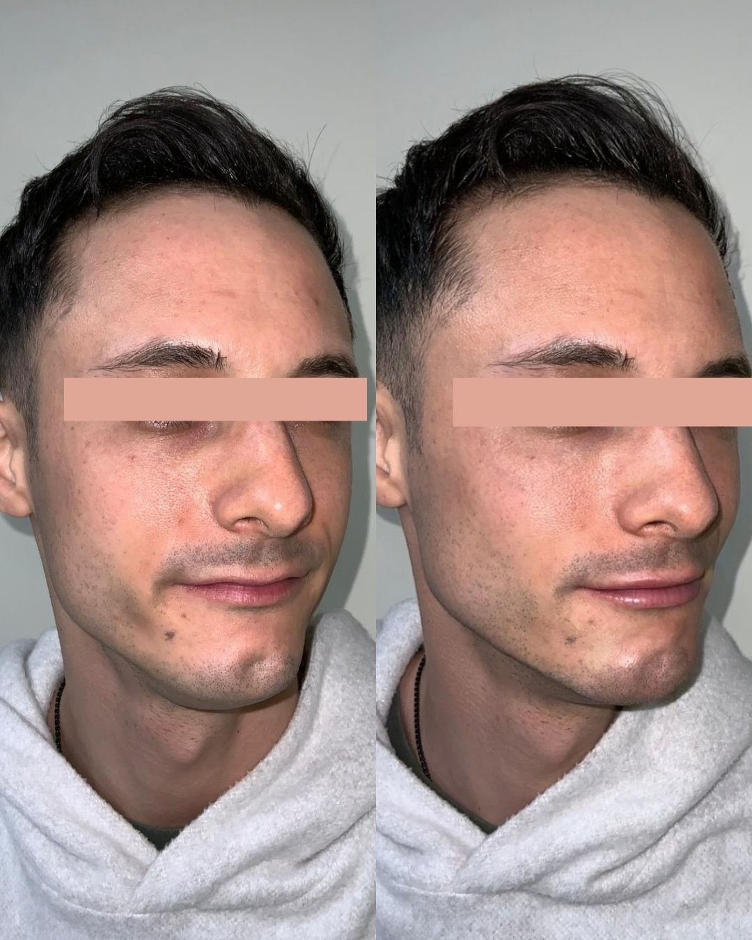 Chin Filler for Men