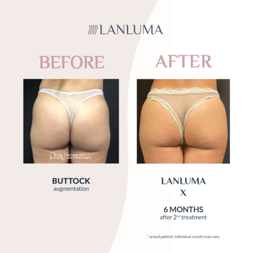 Injectual Buttocks Filler Treatment