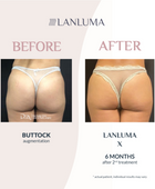 Injectual Buttocks Filler Treatment