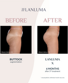 Injectual Buttocks Filler Treatment