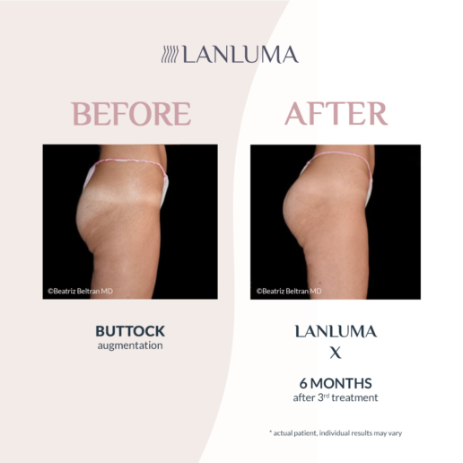 inject melanotan in bum HOW I DO IT - Buttock augmentation Love Island generation' skin cancer