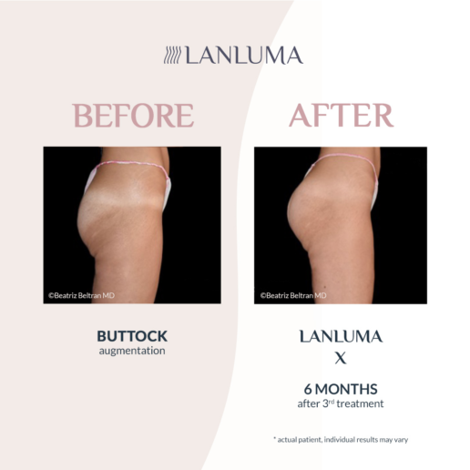 Injectual Buttocks Filler Treatment