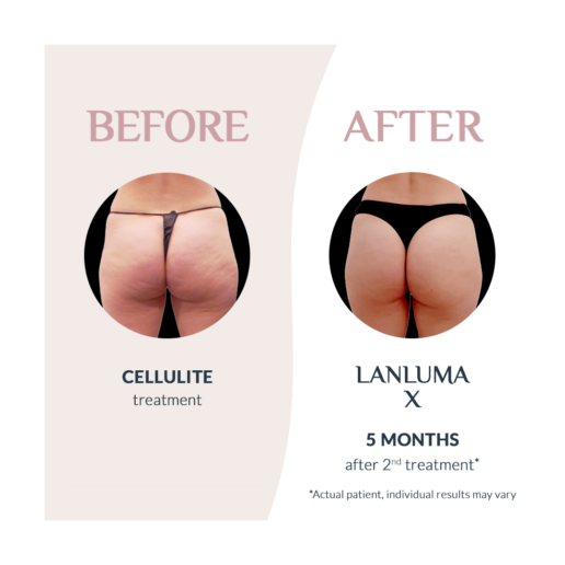 Injectual Buttocks Filler Treatment