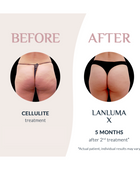 Injectual Buttocks Filler Treatment