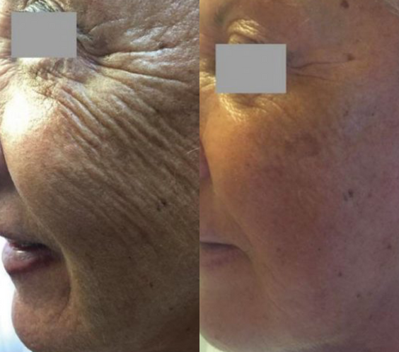 Profhilo® Skinbooster Face Treatment