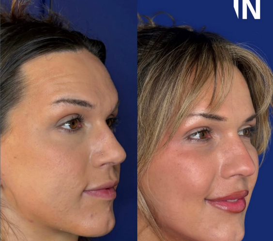OestroLift™ Injectable Non-surgical Feminisation Protocol