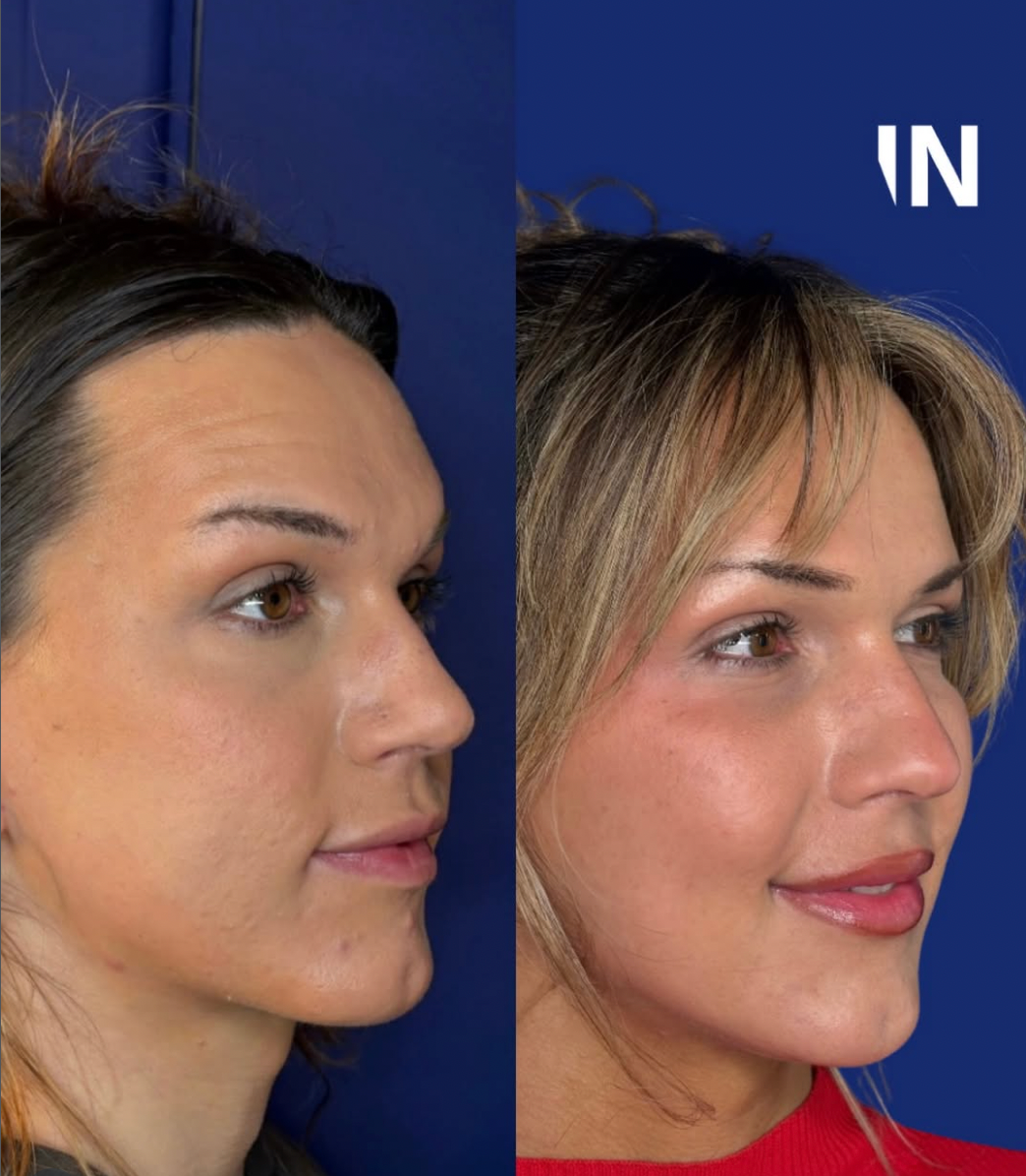 OestroLift™ Injectable Non-surgical Feminisation Protocol