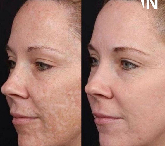 PRX-T33 Skin Peel
