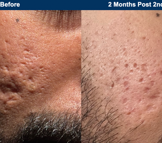 UltraClear Laser Skin Resurfacing